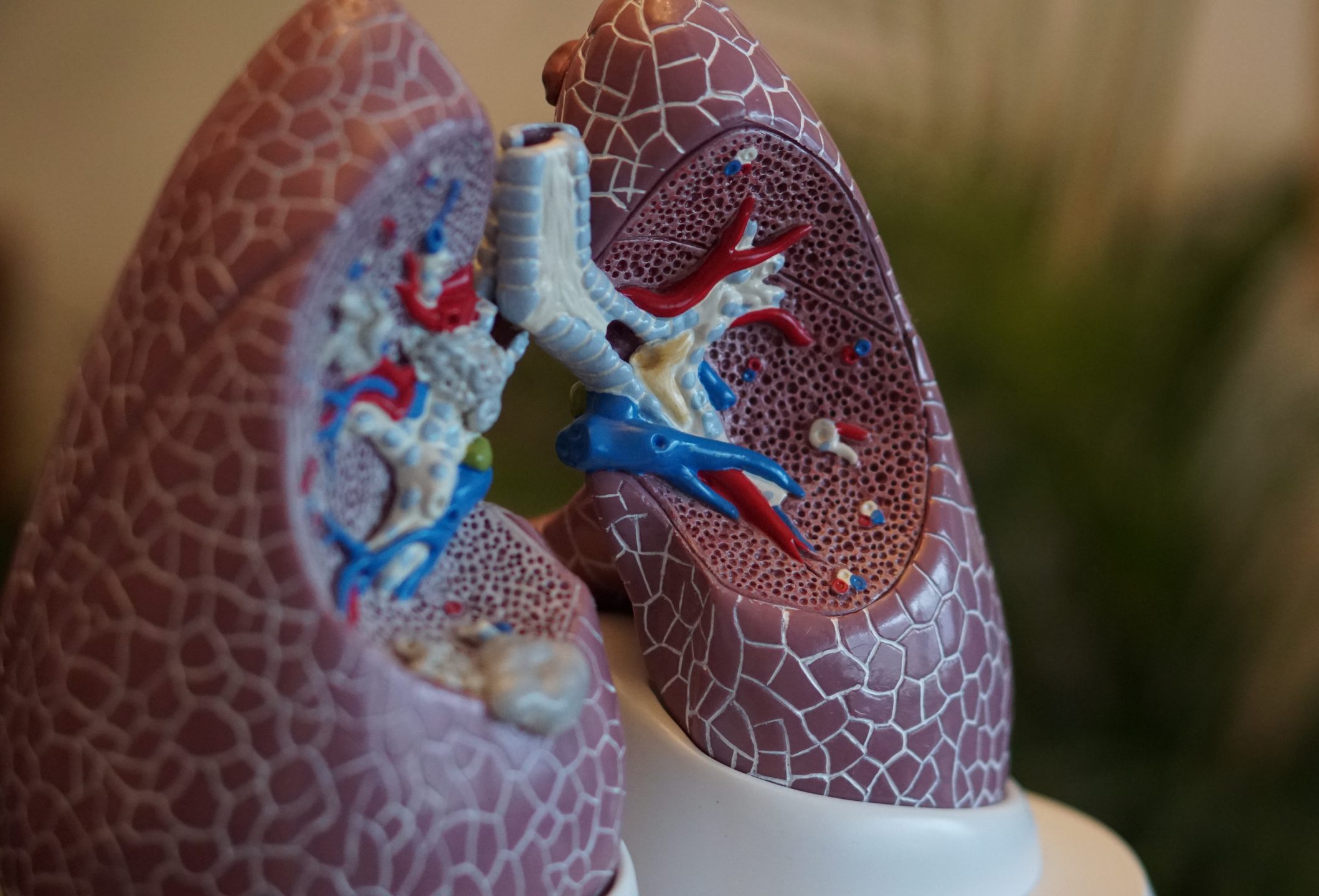 Model of lungs to illustrate cystic fibrosis