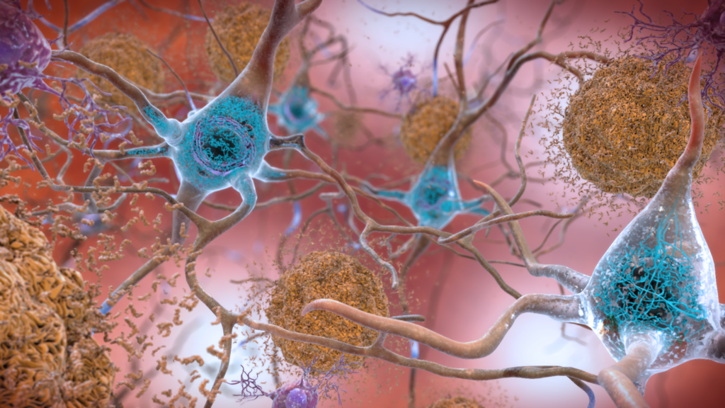 illustration of neurons containing plaques and tau clusters as found in progressive supranuclear palsy