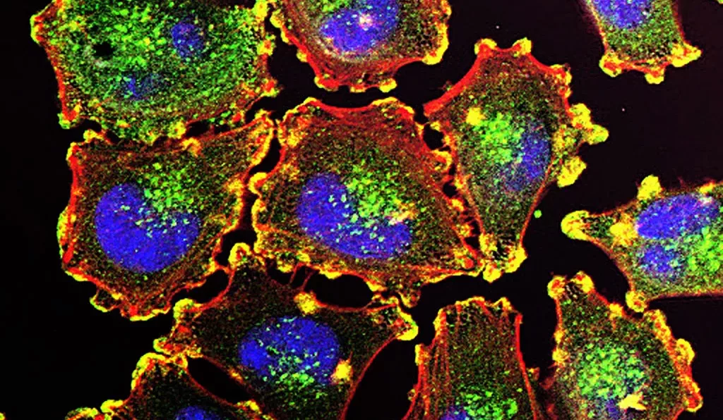 Melanoma cells imaged under a microscope